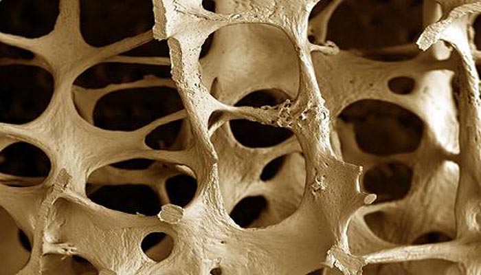 cropped-osteoporosis cropped-osteoporosis